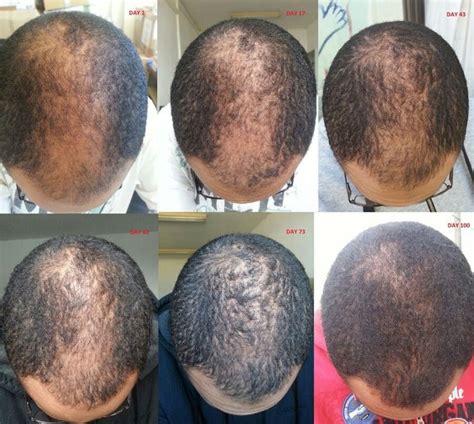 Minoxidil Before and After Photos [2022] | Is it right for you?