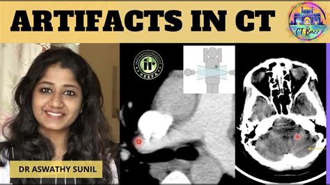 CT ARTIFACTS by Dr Aswathy Sunil || Helical artifacts - beam hardening - streak artifacts - YouTube