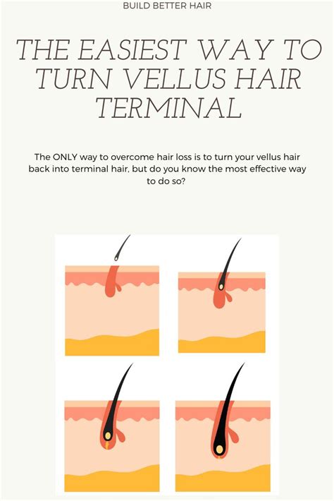 Turning Vellus Hair Terminal Is The ONLY Way To Overcome Hair Loss ...