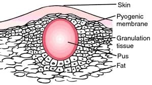 COLD ABSCESS - www.medicoapps.org