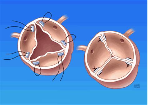 Aortic Valve Repair for Aortic Insufficiency | CTSNet