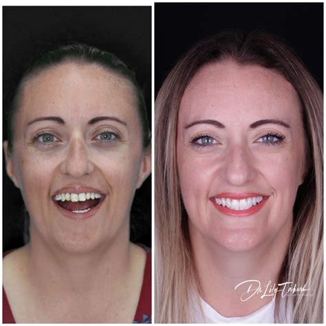 Composite Veneers Perth | Dental Veneers Cost | Connolly Dental