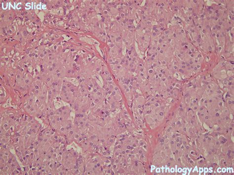 leydig cell tumor pathology