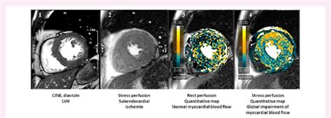 Example of HFpEF due to coronary microvascular dysfunction. Patient... | Download Scientific Diagram