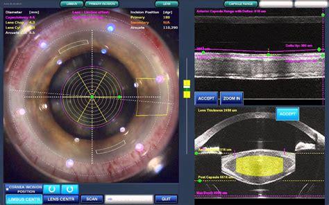 Laser Assisted Cataract Surgery: Is it Worth the Cost? - Eyedolatry