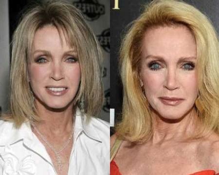 Donna Mills Plastic Surgery Update – Surgery Lists