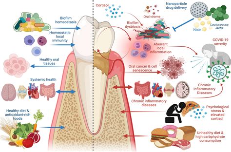 Pathogenesis Of Gingivitis