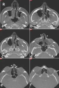 Zygomaticomaxillary complex fracture and orbital blowout fracture ...