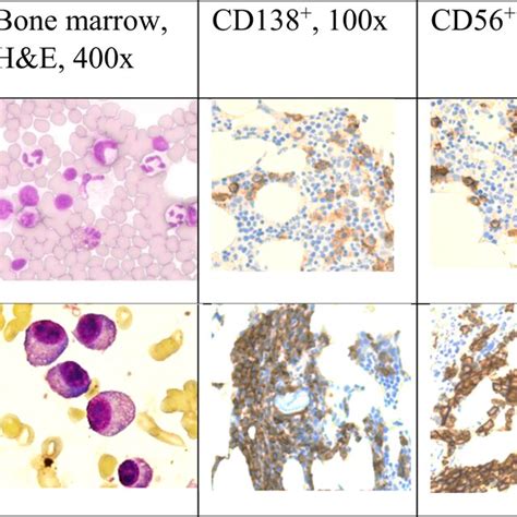 The bone marrow (BM) trephine biopsy sample histopathological... | Download Scientific Diagram