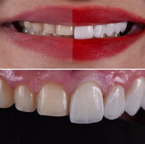 Veneers vs. Lumineers | Dental veneers, Veneers teeth, Happy dental