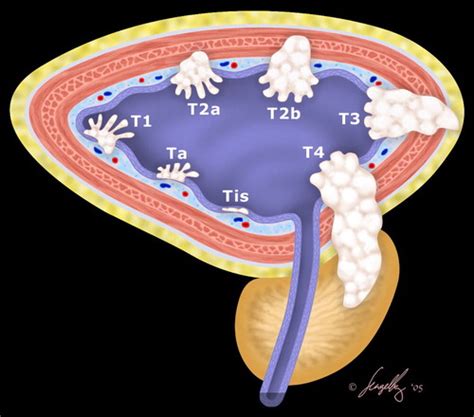 Neoplasms of the Urinary Bladder: Radiologic-Pathologic Correlation | RadioGraphics