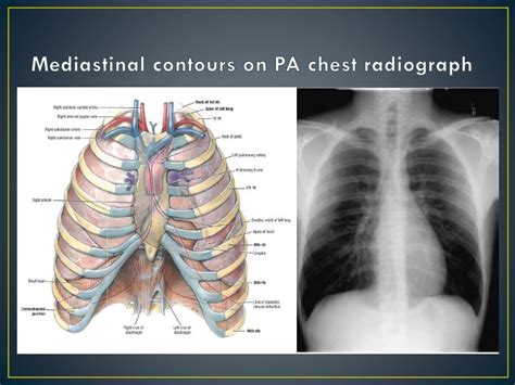 PPT - Imaging Anatomy of the Mediastinum PowerPoint Presentation, free download - ID:2075433