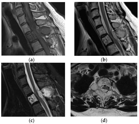 JCM | Free Full-Text | Ethanol Sclerosis Therapy for Aggressive Vertebral Hemangioma of the ...