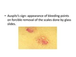 Auspitz Sign Seen In Which Psoriasis - In november the 18th's minerva ...