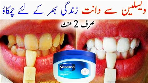 Vaseline For Teeth Whitening - How To Whiten Teeth With Vaseline In 2 ...