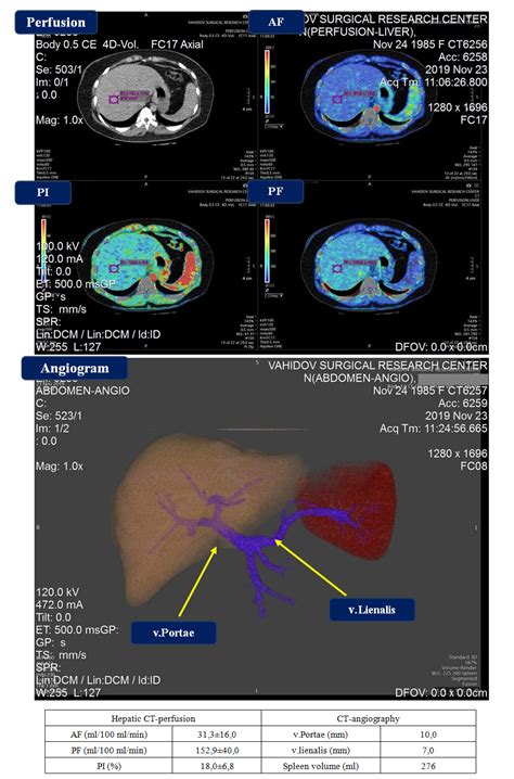 The Features of Liver Perfusion in Various Hepatic Diseases and Portal Hypertension According to ...