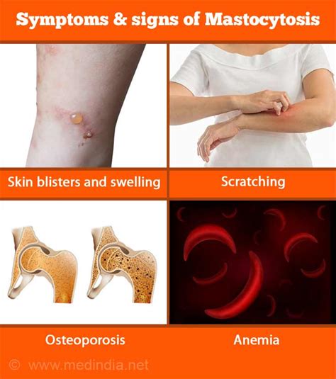 Mastocytosis Systemic Rash