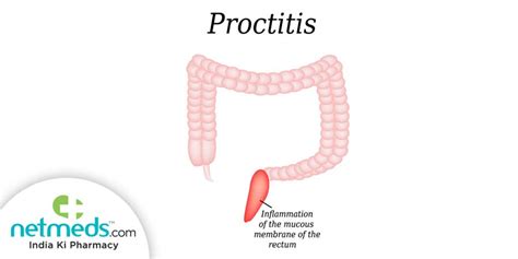 Proctitis Causes, Symptoms and Treatment