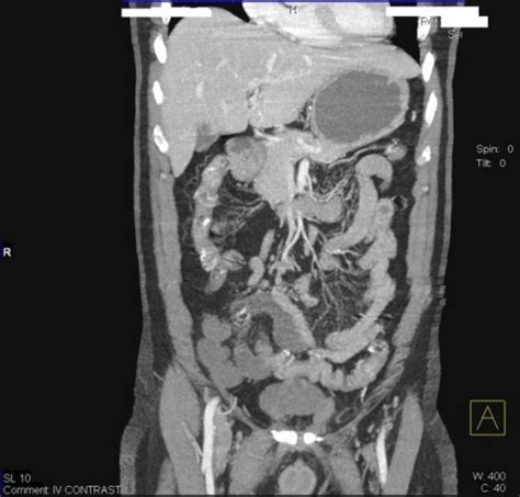 Abdominal Angio CT coronal reconstructed image revealed | Open-i