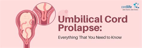 Umbilical Cord Prolapse: Everything That You Need To Know