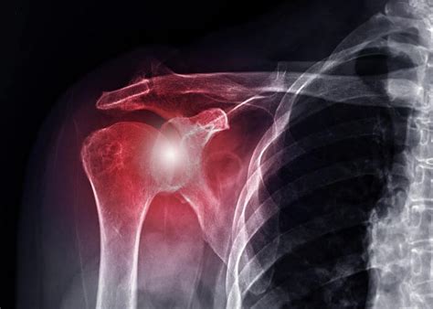 Articular Cartilage Shoulder Injury | Orthopedic Shoulder Specialist ...