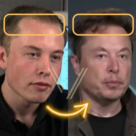 Elon Musk's Hair Transplant: Before and After Transformation