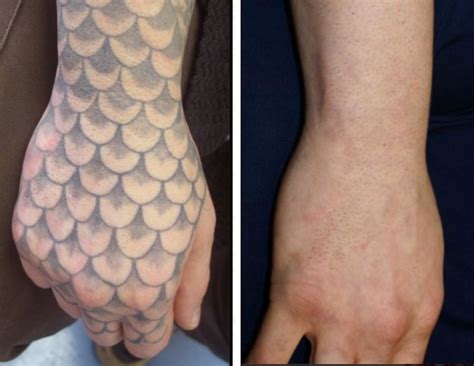 Real Tattoo Removal in Lexington, Ky | See the Before & After Photos