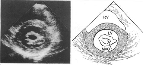 An echocardiographic parasternal short axis view of the mitral valve ...