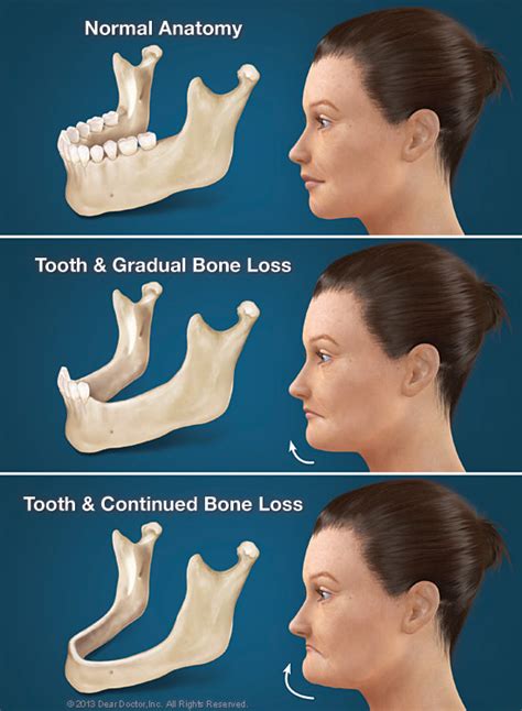 Hidden Consequences of Losing Teeth | Rogers Dental Center | Rogers MN