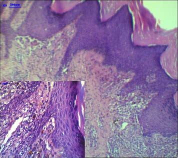 Histology of hypertrophic lichen planus. | Download Scientific Diagram