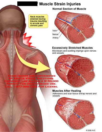 AMICUS Illustration of amicus,injury,muscle,strain,injuries,neck,micro,tear,swelling,adhesion ...