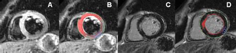 Assessment of myocardial salvage after acute, reperfused myocardial... | Download Scientific Diagram