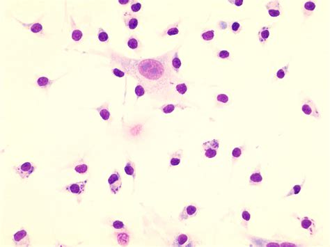 Macrophages infected with the parasite Leishmania donovani (the smaller dark purple dots - the ...