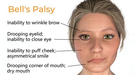 Bell’s Palsy Treatment - Propel Physiotherapy