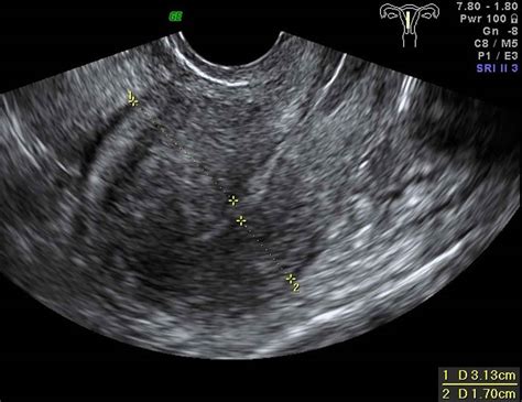 Adenomyosis, adenomyosis & pregnancy, symptoms, diagnosis & treatment