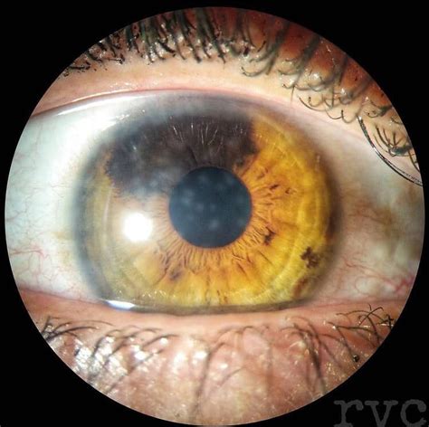 Nummular keratitis: •... - Ophthalmology-Notes And Synopses