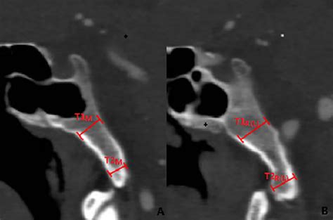 Thickness of clivus. 3A: Measurement of the thickness of the clivus in... | Download Scientific ...