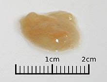 What the heck does rust colored sputum actually look like? : r/medicalschool