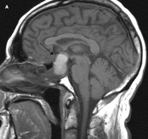 Pituitary Apoplexy | Consultant360