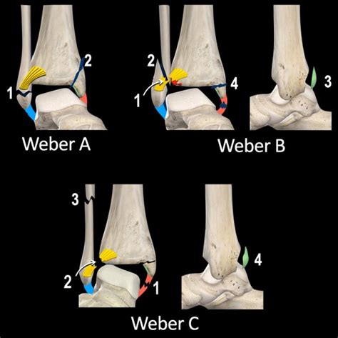 The Radiology Assistant : Algoritm for Ankle Fractures 2.0