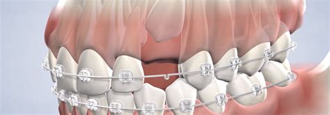 Impacted Canines in Aliso Viejo, CA | OC Oral Surgery