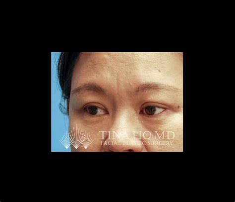 Upper Eyelid Surgery: Before and After - Video - RealSelf