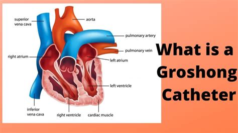 What is a Groshong Catheter - YouTube