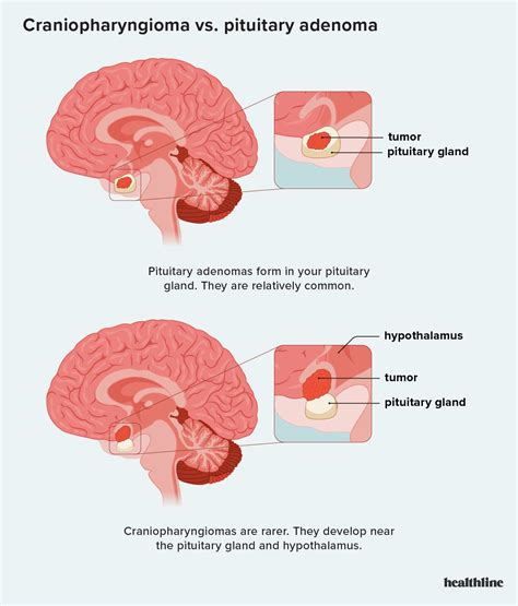 Craniopharyngioma vs. Pituitary Adenoma: Similarities and Differences