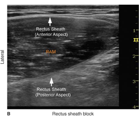 Rectus Sheath Block Anatomy