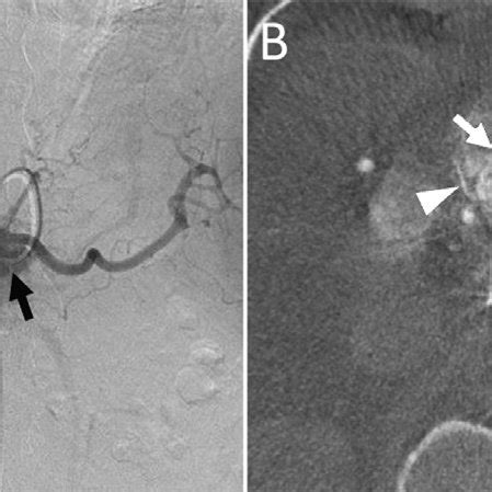 -(A) Angiography of the celiac trunk, showing mass-like enhancement ...