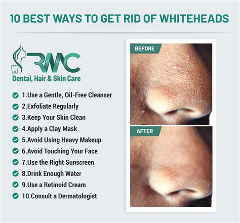 10 Ways to Get Rid Of Whiteheads | Rehman Medical Center