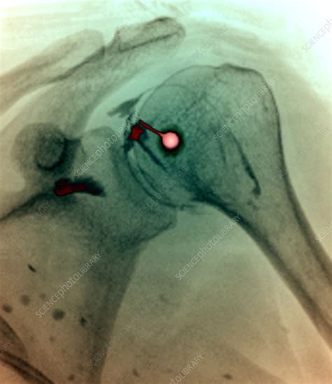 Adhesive capsulitis treatment, X-ray - Stock Image - C058/0261 - Science Photo Library