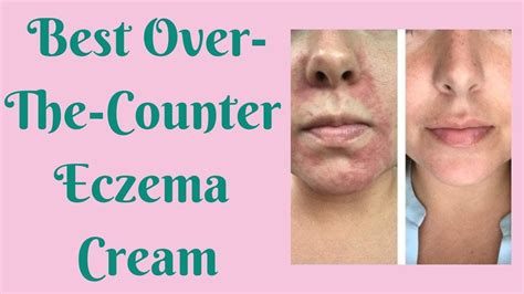 Best Over-The-Counter Eczema Cream | Eczema cream, Eczema, Skin tags ...