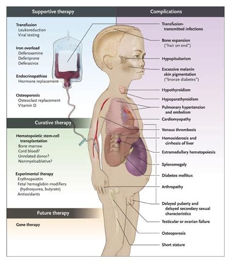 Image result for thalassemia effect on the body | Pediatric nursing ...